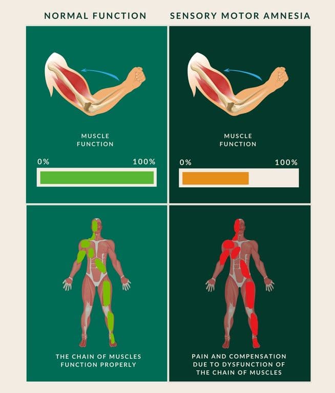 Comparison diagram: normal muscle function, with full range of movement and muscles shown in green, versus sensory motor amnesia, with reduced function and areas of pain and compensation shown in red